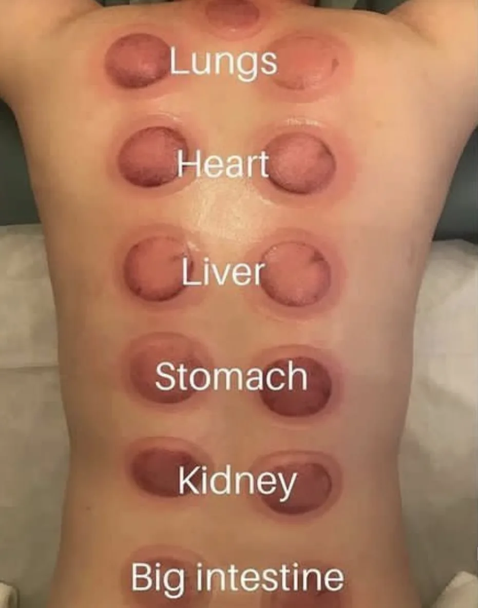 Intrinsic Hands treatment photograph: cupping diagram