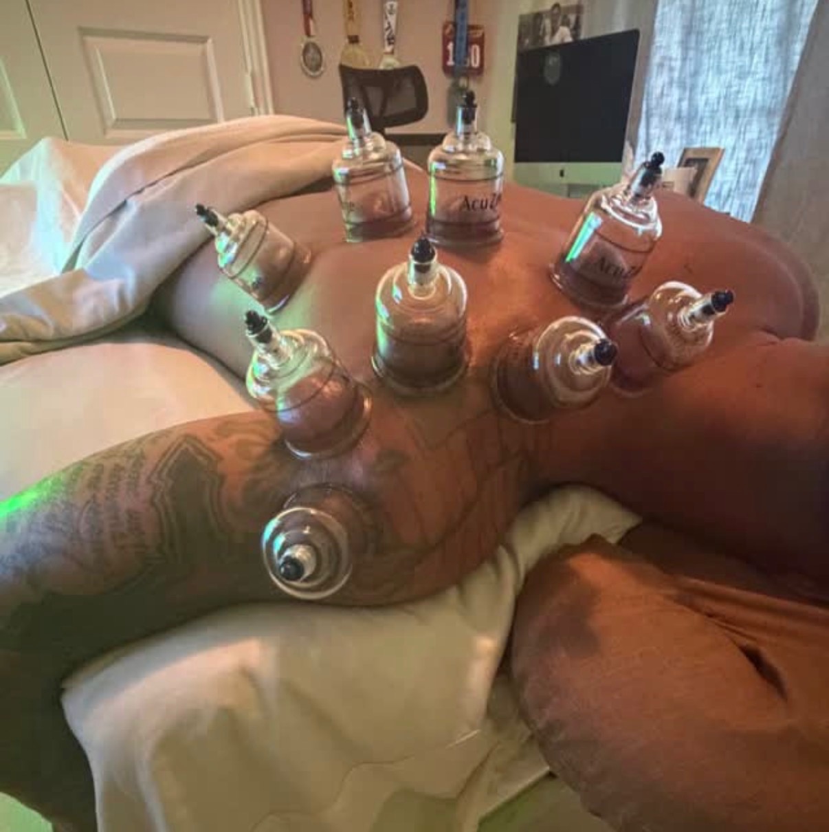 Cupping therapy on legs