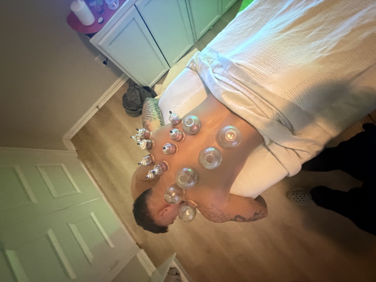 Cupping therapy on upper leg